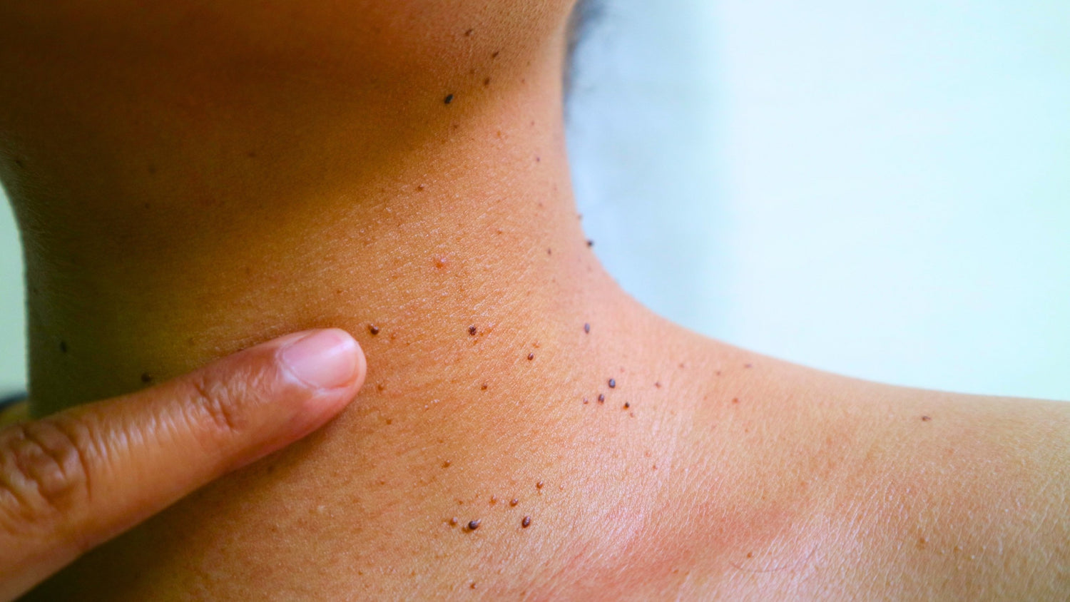 How to Treat Skin Tags on Black Skin